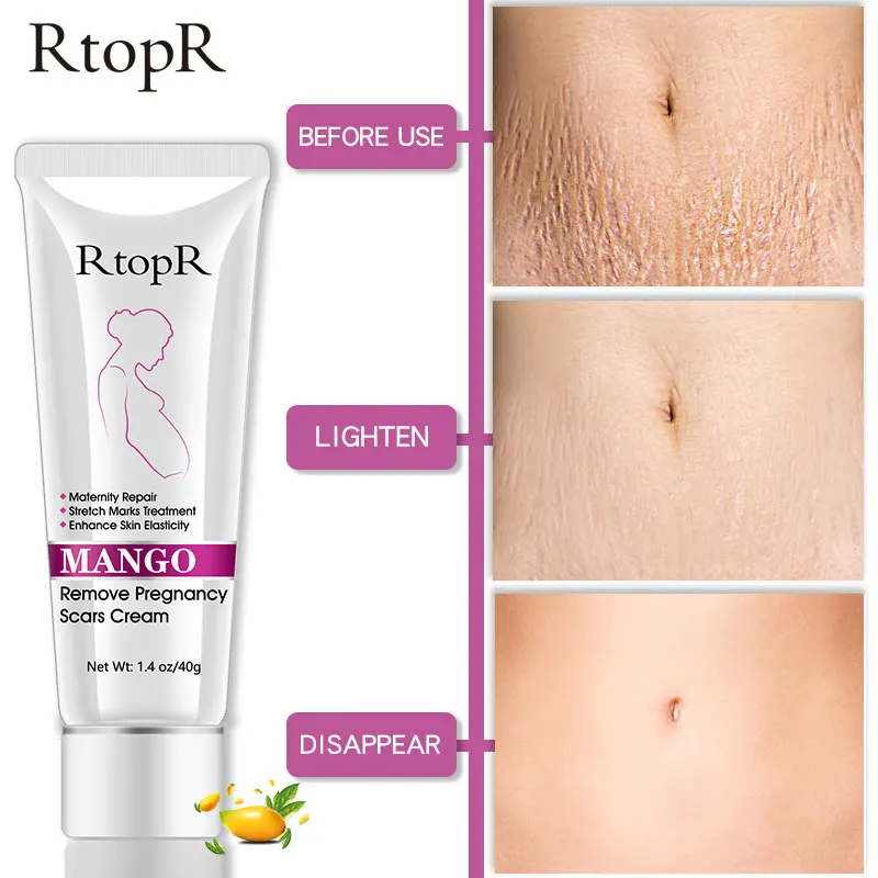 

10pcs Mango Remove Pregnancy Scars Acne Cream Stretch Marks Treatment Maternity Repair Anti-Aging Winkles Firming Body Cream