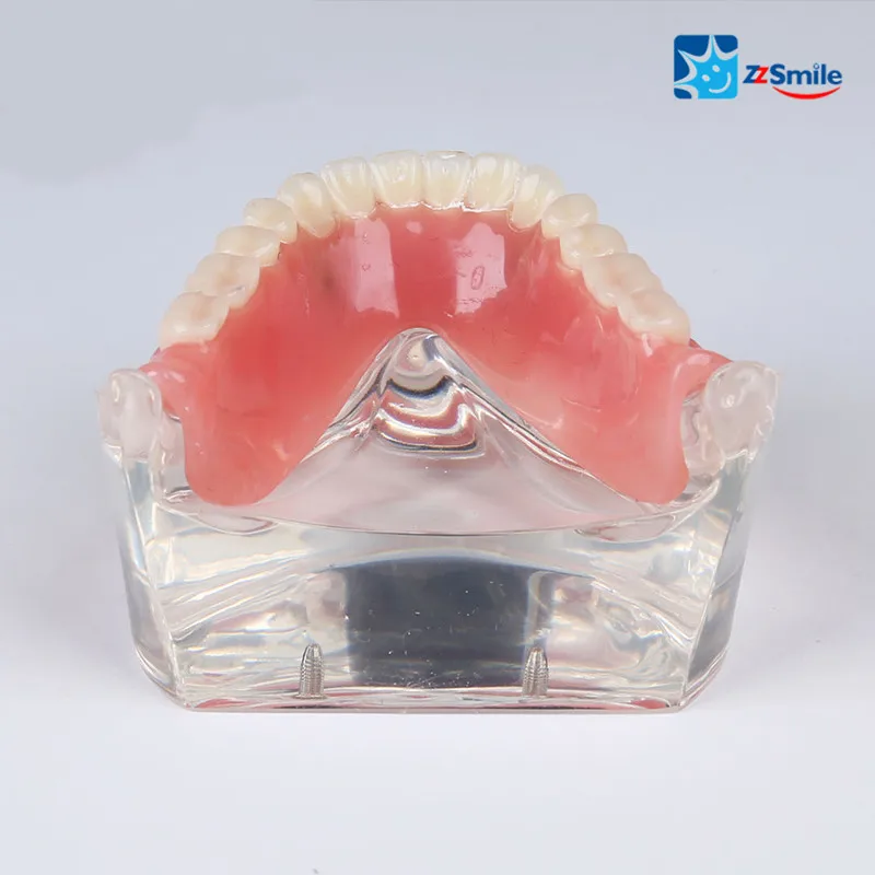 M6002 сверхпротез низшая модель с 2 имплантатами/стоматологическая демонстрационная модель