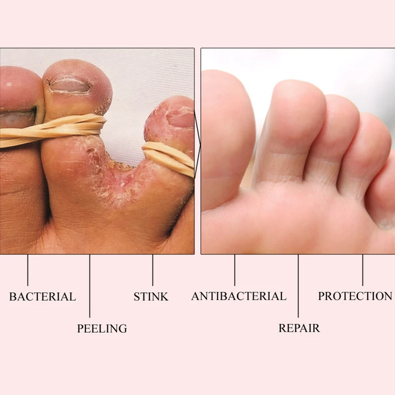 Tratamiento de pies a base de hierbas contra la infección micótica partratamiento eficaz del hongo del dedo del pie Reparación de crema para el cuidado de los pies Tratamiento de pies a base de hierbas contra la infección micótica partratamiento eficaz del hongo del dedo del pie Reparación de crema para el cuidado de los pies