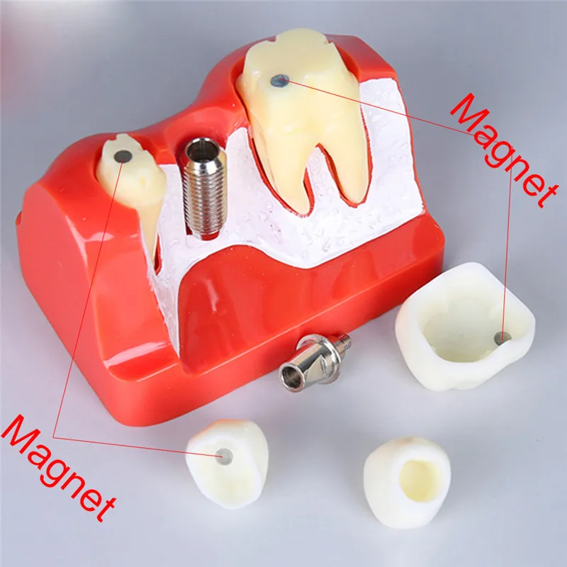 4 раза Стоматологическая имплантатная модель анализа с восстановлением Корона мост демонстрация Стоматологическая модель зубов для обучения