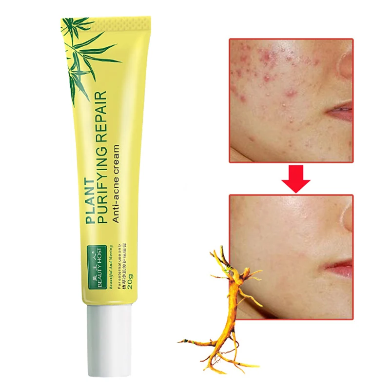 

20g Acne Scar Removal Cream Face Skin Care Spots Blemish Marks Treatment 88