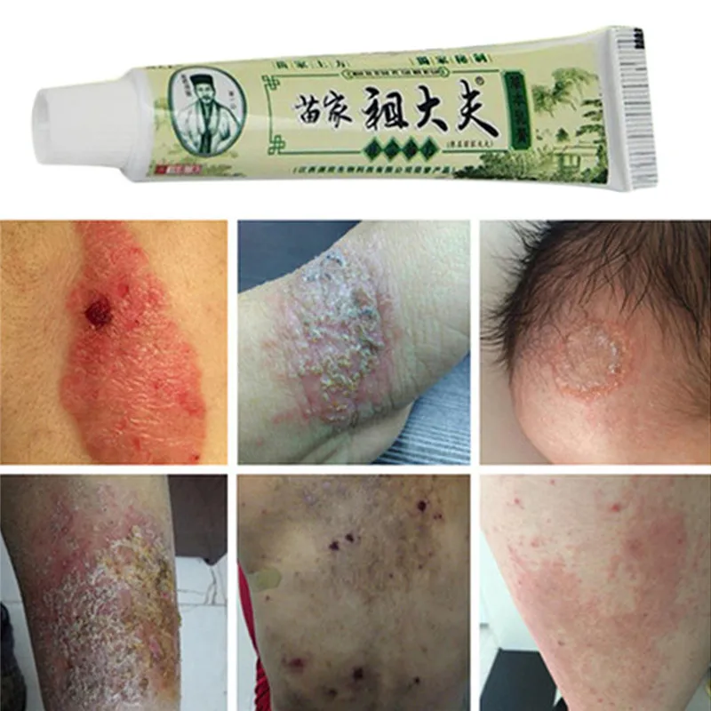 12-Pcs-ZUDAIFU-Body-Psoriasis-Cream-Ointent-for-Dermatitis-Eczema-Pruritus-Psoriasis-Skin-Care-Ointment-With