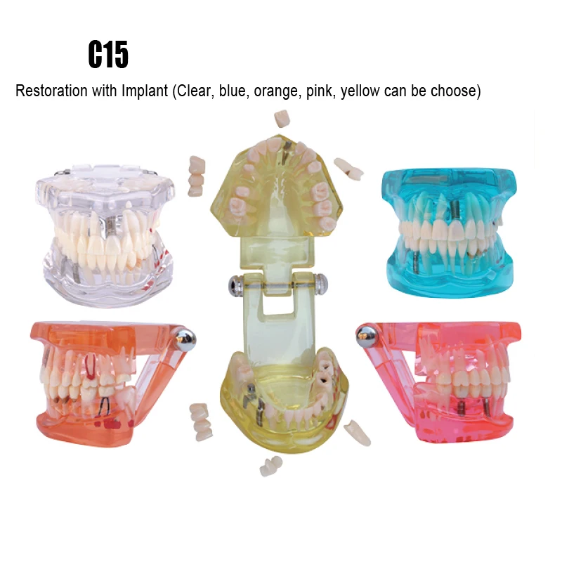 Стоматологическая реставрация модель имплантата зубы модель для стоматологической практики с пятью цветами