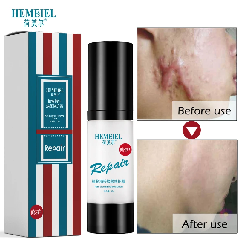 

HEMEIEL Herb Essence Acne Scar Stretch Marks Remover Cream Skin Care Repair Face Cream Surgical Burn Scar Corrector Treatment