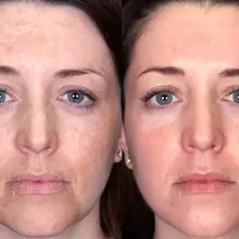 Гликолевый кислотный химический пилинг силы путем ана-10% 20% 30% 40% 50% 60% 70% 1oz