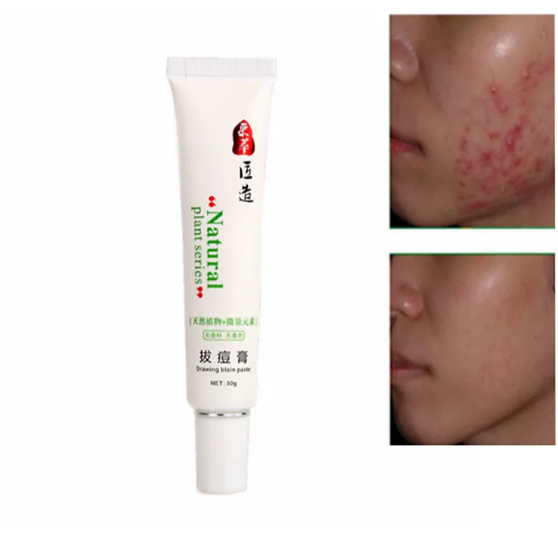 

CAICUI 30g Anti Acne Cream Oil-control Shrink Pores Face Cream Acne Scar Remove Repair Skin Whitening Cream Moisturizer