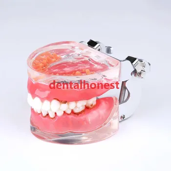 Dental Typodont Teeth Model Adult Pathological Periodontal disease 4017# tools nitric oxide and periodontal disease