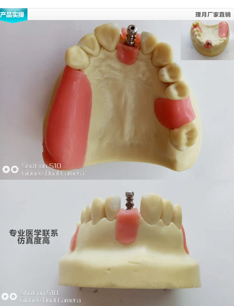 Стоматологические материалы модель орального имплантата хирургические maxillary sinus Стоматологические принадлежности оборудование инструменты мягкие десны