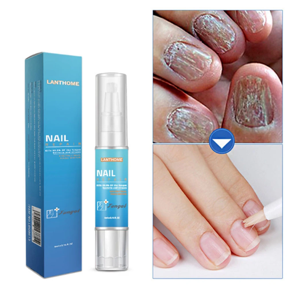 

4ml Chinese Nail Treatment Pen Onychomycosis Paronychia Anti Fungal Nail Infection Herbal Toe Nail Fungus Care Plaster D004