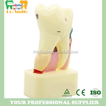 

4:1 Dentist Dental Study Teach Tooth Model Teeth Disease Model