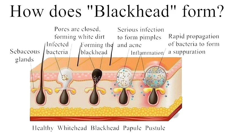 how does blackhead form