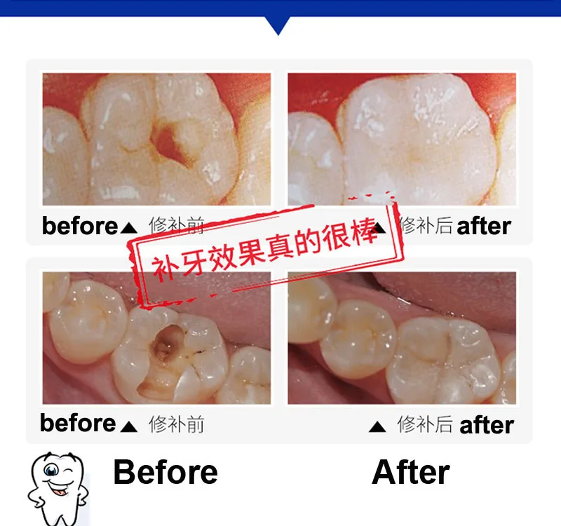 Cola de Enchimento Kit de Acessórios Dentes da Cavidade Dental Dentista Enfermeira Médico Selo Vínculo Dente Reparação Ferramenta Correção Adesiva Médica Cuidados Cura 7 Cheap Cola líquida