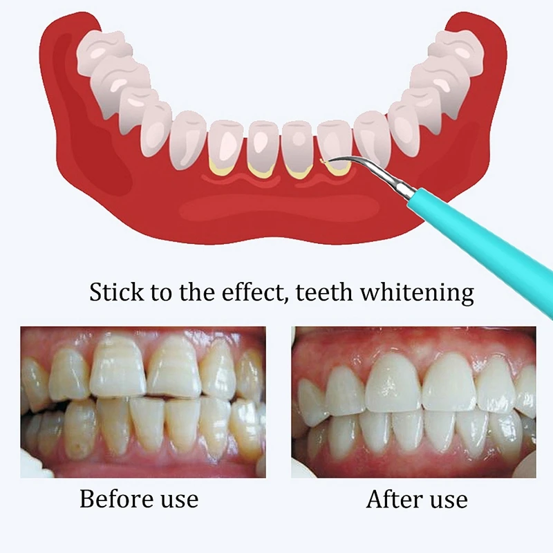 Новое отбеливание полости рта, Домашнее использование, средство для удаления пятен на зубах, средство для удаления пятен на зубах, зубной камень, машина для чистки зубного камня