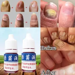 Грибок ногтей Лечение 1 pc противогрибковые ногтей решение лишай ясно здоровой ногти роста ногтей Лидер продаж