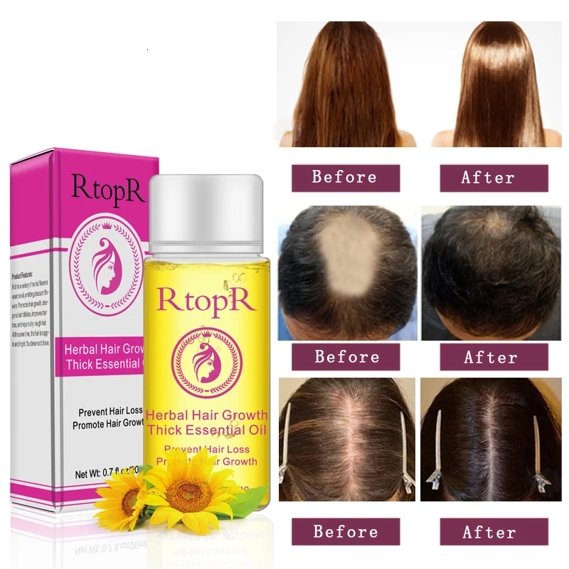 Rtopr New Hair Growth Essential Oil 20ml Herbal Fast Hair Growth Longer Thick Essence Professional Anti Hair Loss Products Hair Loss Products Aliexpress