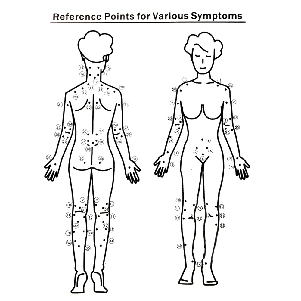 Точки эрба для миостимуляции схемы с цветными электродами