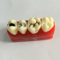 Учебная модель для стоматологов для ямы и деления уплотнения лечения зубов Модель 2018