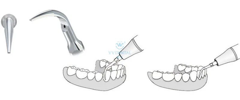 3 шт. G1 зубные наддесневое масштабирование наконечник для ультразвукового инструмента для снятия зубного камня Совместимость с EMS woodpecker