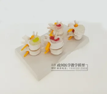 

4 pcs different level one set Medical human Lumbar disc hernia Demo Model demonstration model spine model