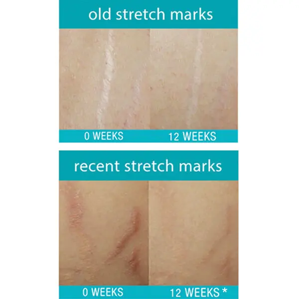 eraser cream for stretch marks