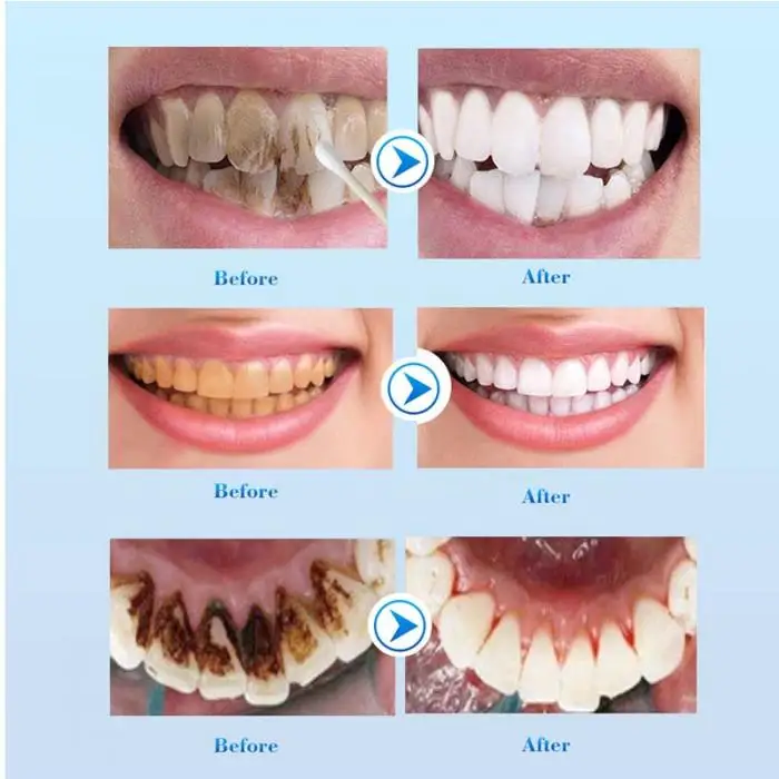 Зубы отбеливающая жидкость гигиена полости рта удаляет зубной налет пятна зуб Очищающая эссенция @ ME88