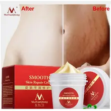Высококачественные гладкие крем для кожи Для Удаления растяжек шрамов для ремонта кожи материнства крем для тела крем от прыщей уход послеродовой