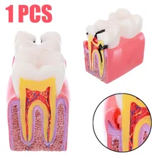 1pc Dental Anatomy Education Teeth Model 6 Times Caries Comparation Study Models For Dentist Studying and Researching 1pc Dental Anatomy Education Teeth Model 6 Times Caries Comparation Study Models For Dentist Studying and Researching