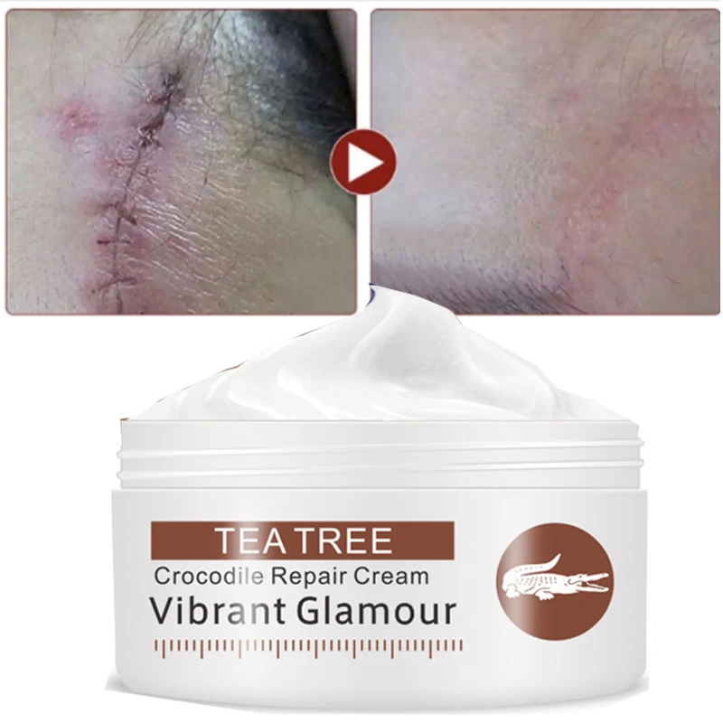 

80% Scar Effect Crocodile Repair Face Cream Acne Scar Removal Whitening for Spots Acne Treatment Stretch Marks Skin Care Cream