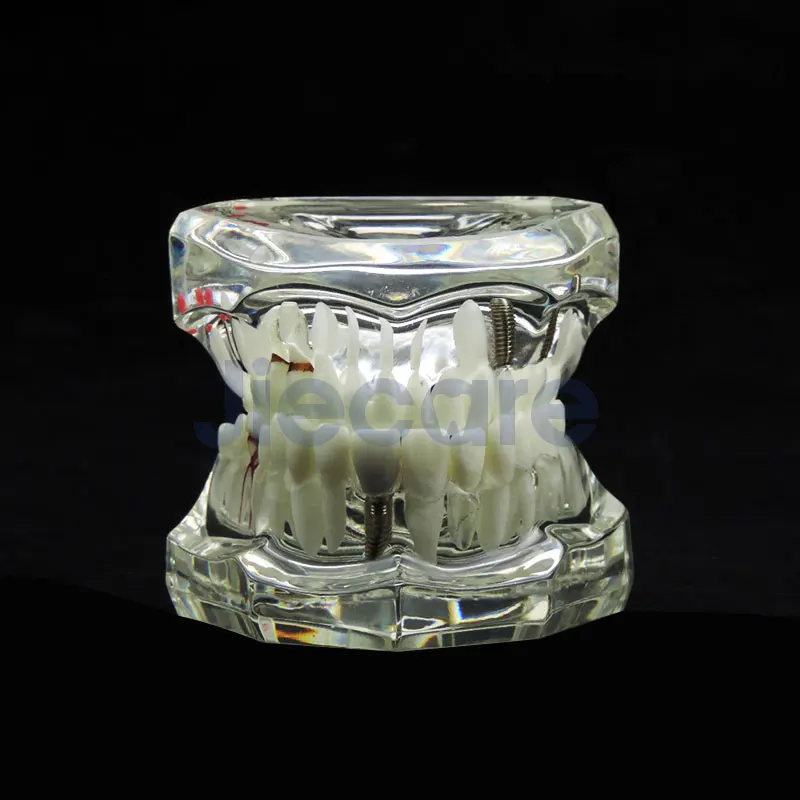 Transparent Adult Pathological Teeth Model Fit for Adult Teaching Study