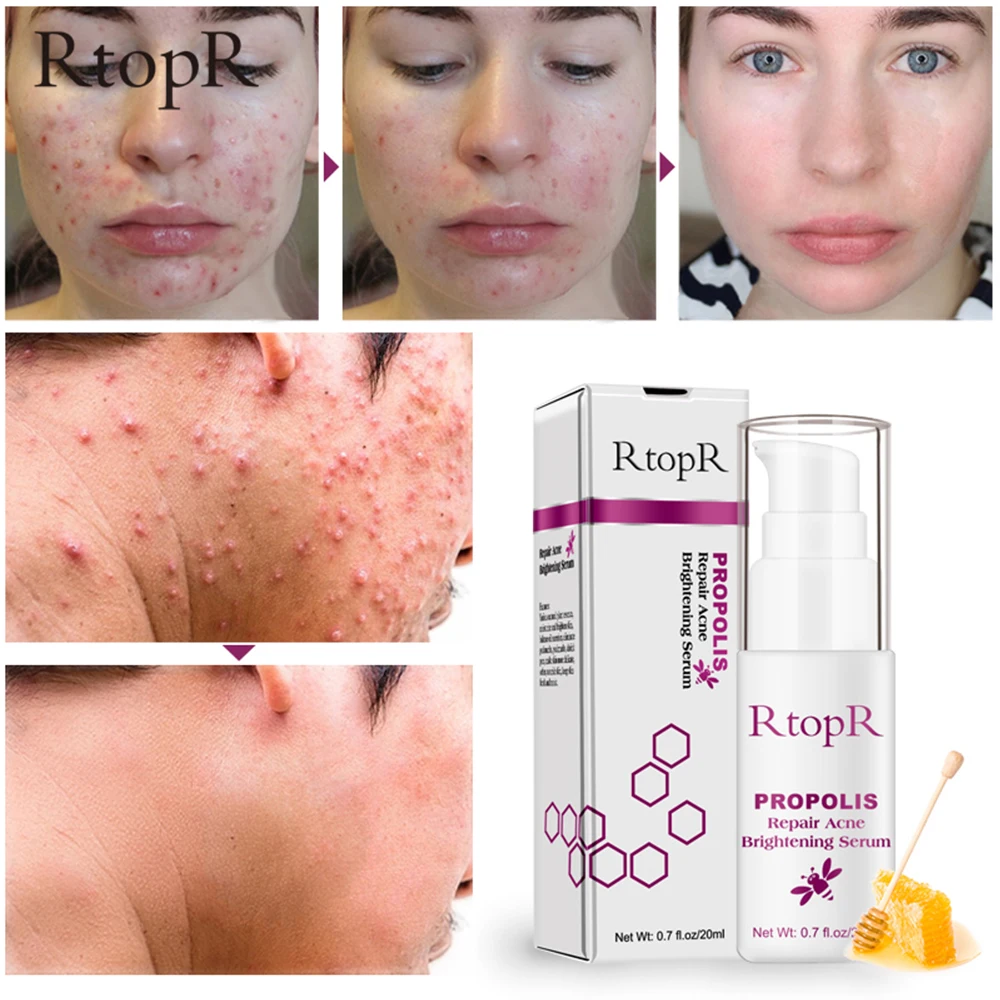 propolis acne care serum