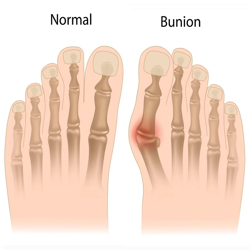 2Pcs Bunion Corrector Pedicure Device Bone Thumb Hallux Valgus Correction Foot Care Tools Orthopedic Protector Toes Separator