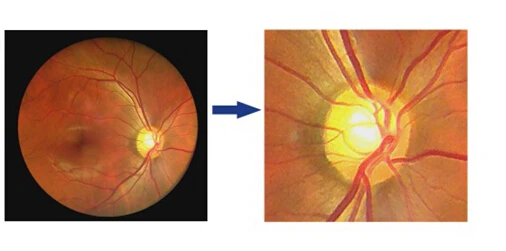 Портативная фотокамера eye fundus с цифровым сканированием сетчатки