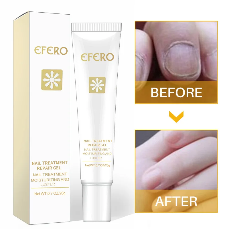 Efero Nail Fungus Treatment Onychomycosis Paronychia Anti Fungal Nail Infection Herb Good Result Toe Nail Treatment TSLM2