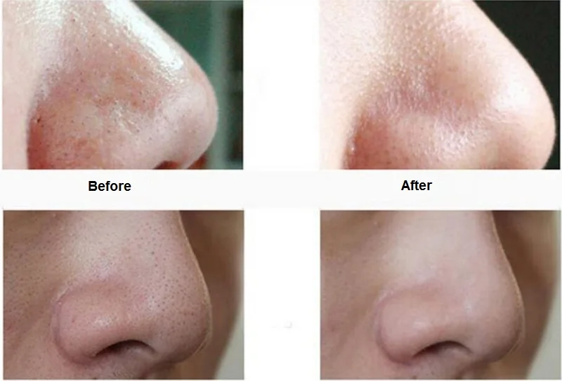 suction pore cleaner