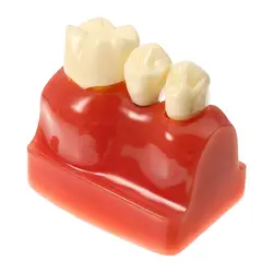 Новые 4 раза зубной имплантат заболеваний зубов Модель с восстановлением мост корона для Медицинские товары обучения демонстрации 2018 Новый