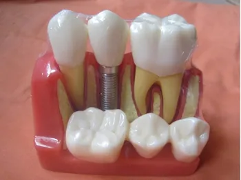 

Dental teeth model dental planting teeth model decomposition tooth model exploded removable dental teaching model