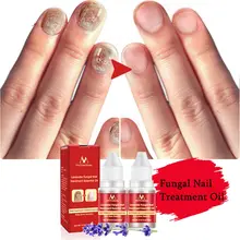 10 мл противогрибковые удаление ногтей инфекция травяное Лечение ногтей от грибка эфирное масло носок для ногтей Paronychia гель для ухода за ногтями Onychomy