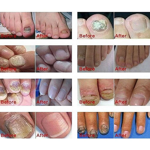 Восстанавливающий Гель лак для ногтей Новое поступление|onychomycosis treatment|fungus treatmentnail