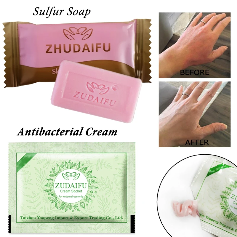 1PC zudaifu Sulfur Soap add 1PC zudaifu Psoriasis Cream Dermatitis