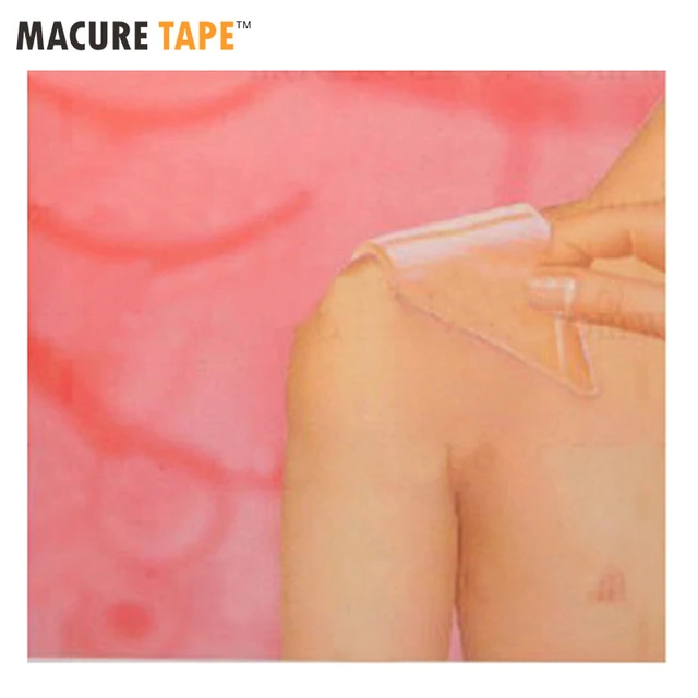 12cm 8cm patches silicone gel scar away therapy wound scar paste silicone sheets for keloids reviews