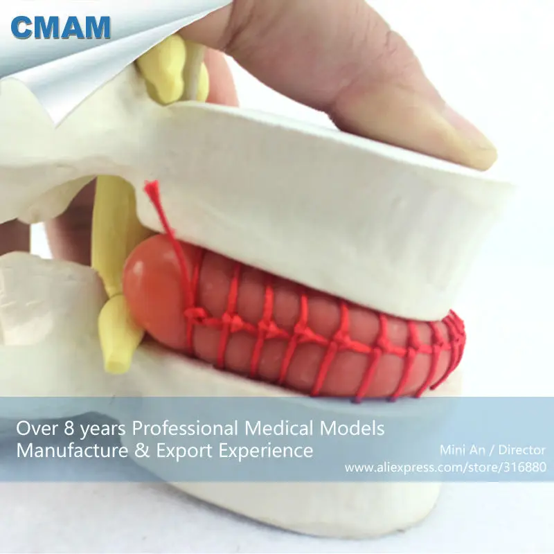 

CMAM/12392 Slipped disk,Disc herniation, 1.5x, Medical Backbone Anatomical Human Model