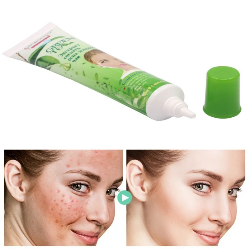 green tea acne cream