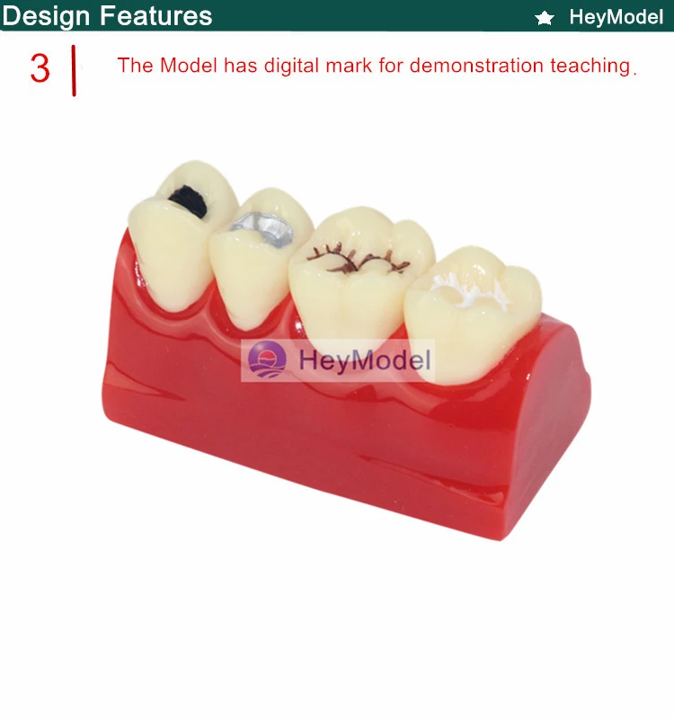 Heymodel зубы ямы и трещины Модель Стоматологическая dentition модель