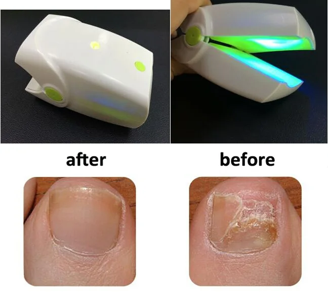 Диодный низкоуровневый лазер терапия LLLT грибок для ногтей Лечение онихомикоза устройство инструмент противогрибковые перезаряжаемые домашнего использования CE