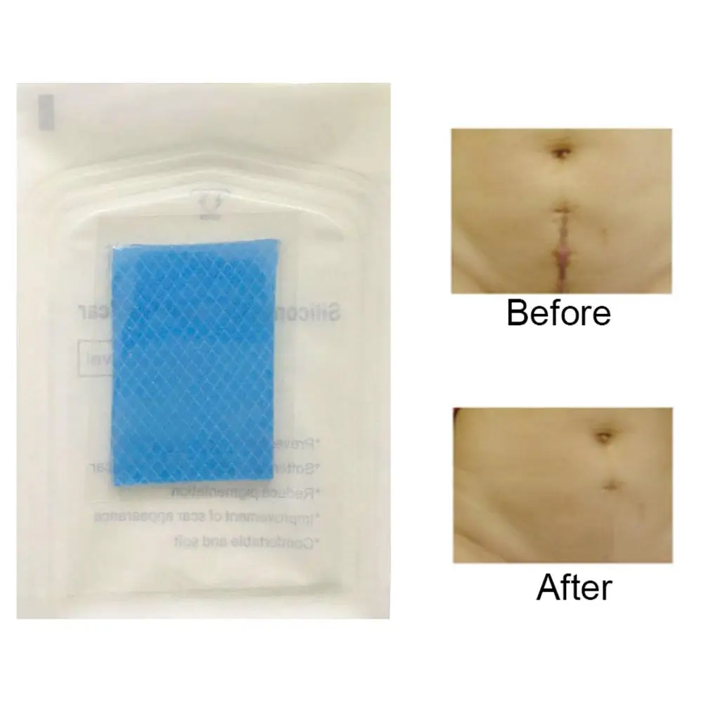 

Silicone Caesarean Surgery Scar Removal Sheet Repairing Acne Trauma Burn Patch hot sale