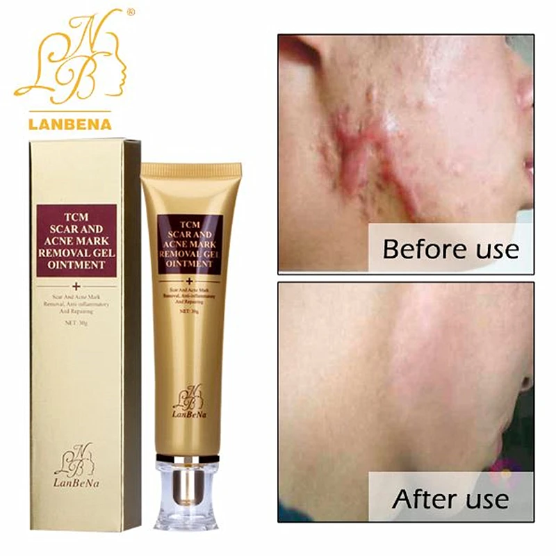 LANBENA крем для удаления шрамов от акне крем для восстановления кожи крем для лица Лечение угрей отбеливающий Осветляющий крем с меланином