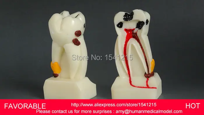 

DENTAL MATERIALS TOOTH PATHOLOGY DISSECTION MODEL DECAYED TOOTH ,4X COMPREHENSIVE DENTAL PATHOLOGY MODEL-GASEN-DEN044
