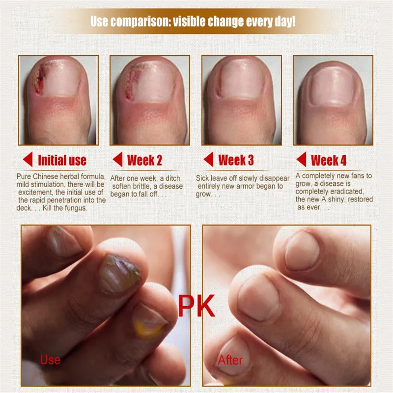 1 Bottle 30ml Anti-fungal Effective Toe Treatment Essence Oil Feet Care Nail Polish Removal Onychomycosis TSLM2