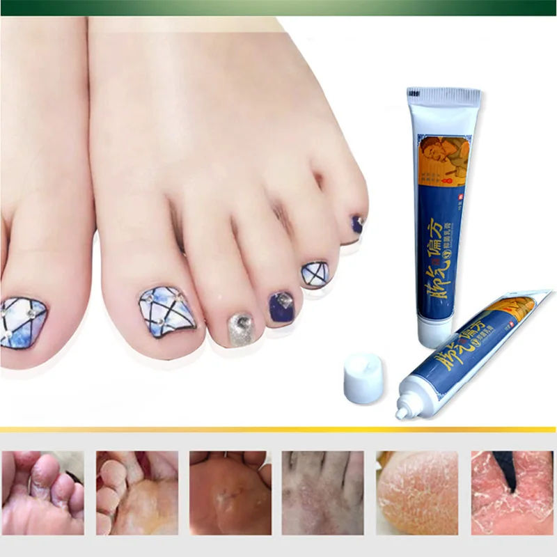 Foot odor Treatment Cream Remove Fungus Removal Relieve Itching