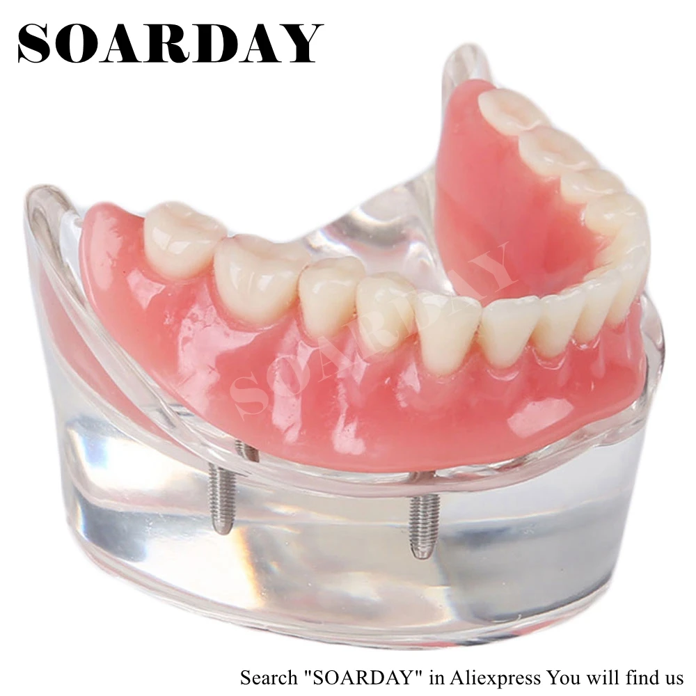 SOARDAY Dental Restoration Model with 4 implants Overdenture Inferior Teaching Study Teeth Model цена SOARDAY Dental Restoration Model with 4 implants Overdenture Inferior Teaching Study Teeth Model цены онлайн